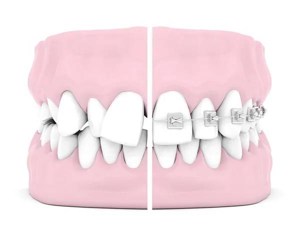 ortodoncia dental brackets